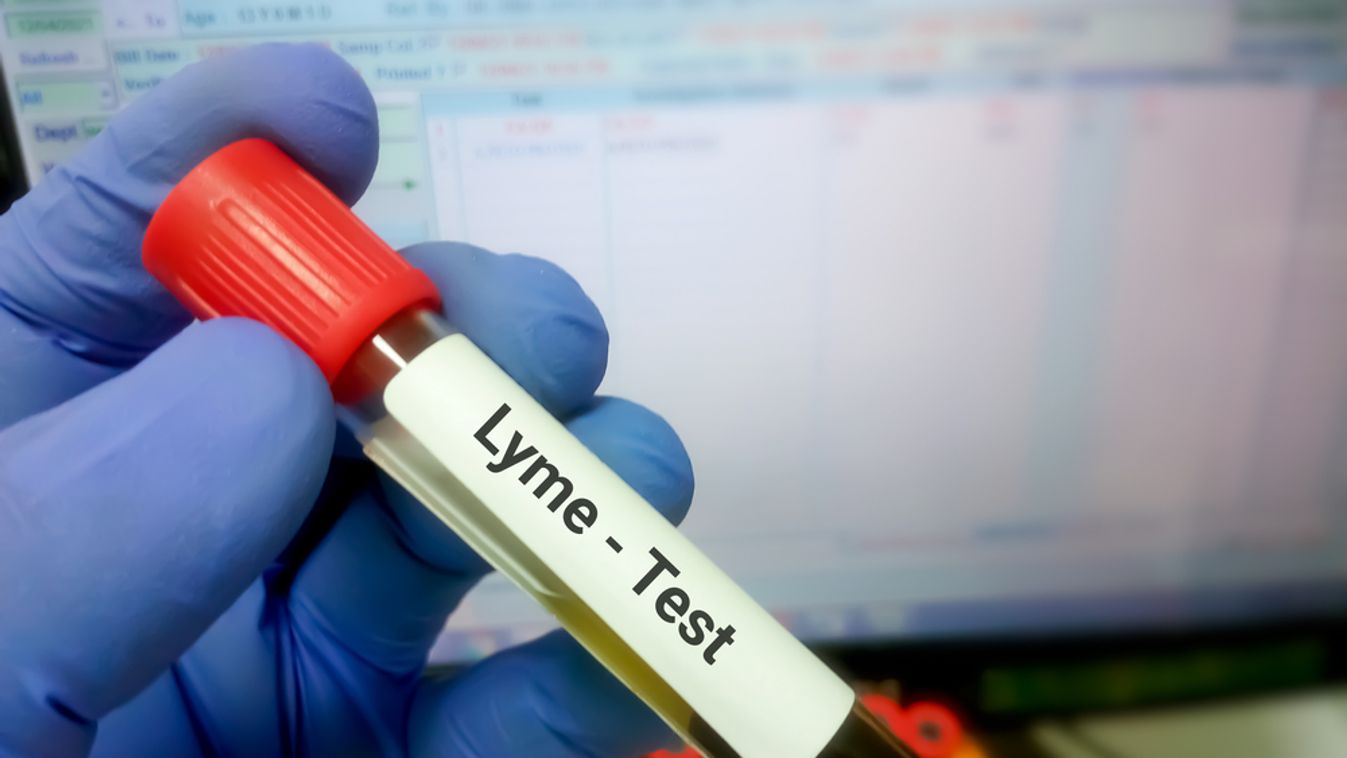 Blood,Sample,For,Lyme,Disease,Testing